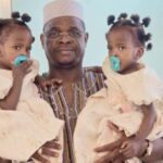 Santé : Opération réussie en Arabie Saoudite pour des sœurs siamoises burkinabè