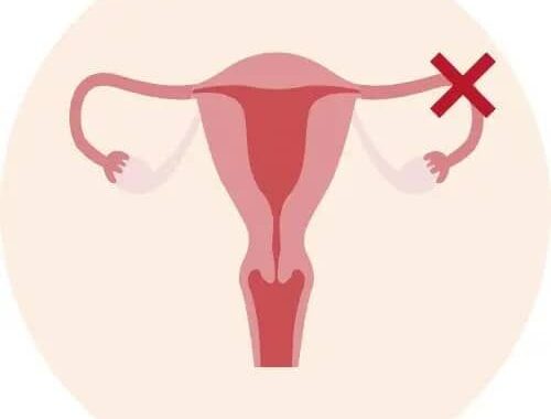 Obstruction des trompes : Ce qu&rsquo;il faut en savoir, selon Pr Charlemagne Ouédraogo